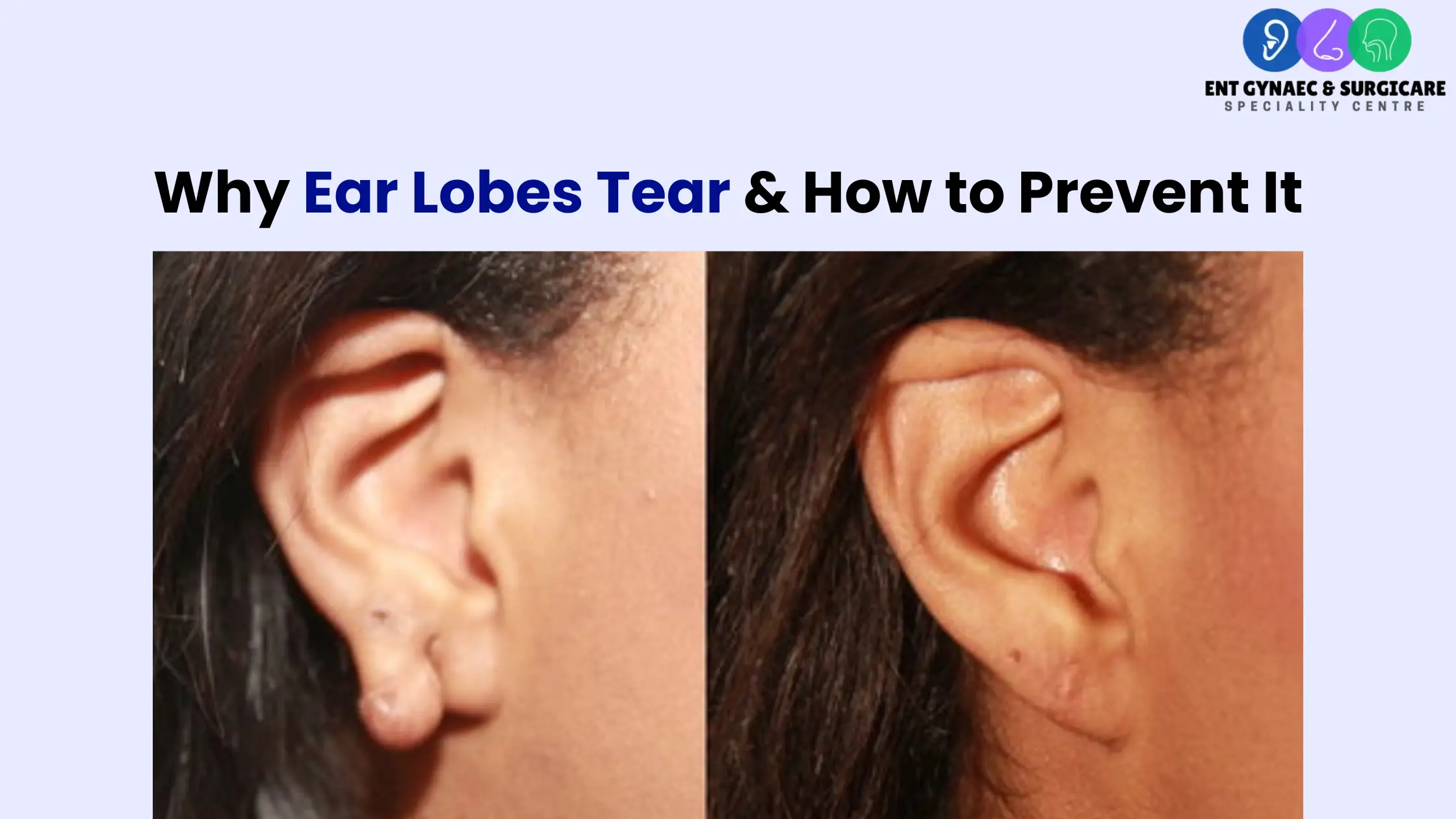 Why Ear Lobes Tear & How to Prevent It