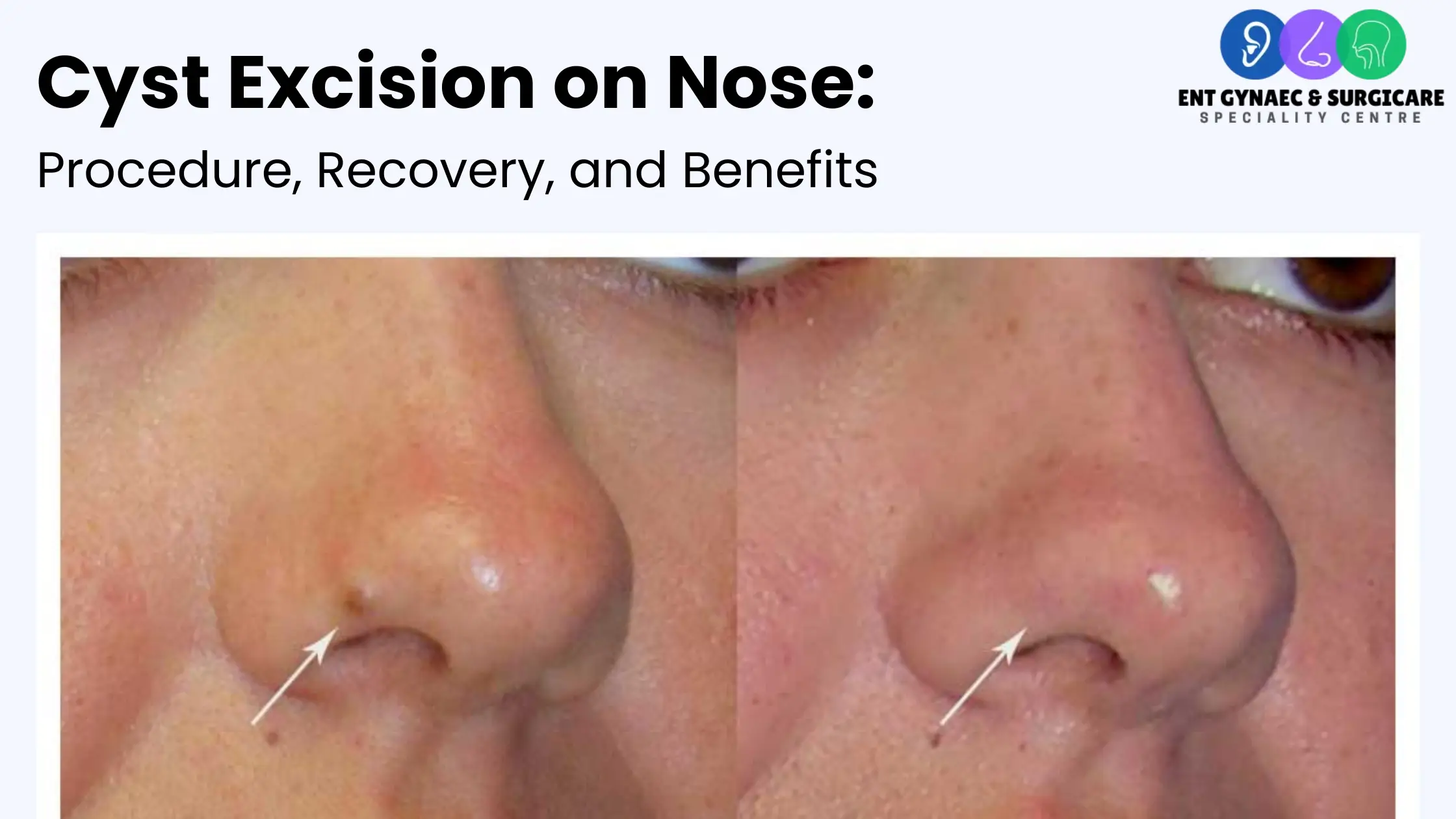 Cyst Excision on Nose: Procedure, Recovery, and Benefits